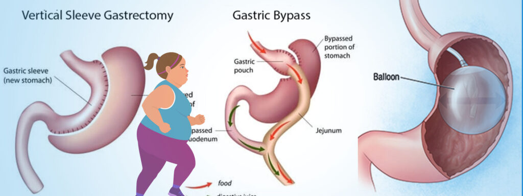 bariatric surgery @the_topmost