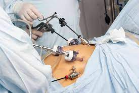 bariatric surgery @the_topmost