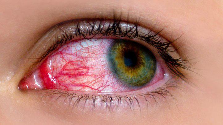 Dry eye is the symptom of covid-19