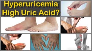 symptoms of high uric acid?