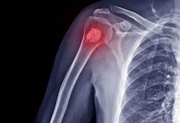 What is a bone tumor?