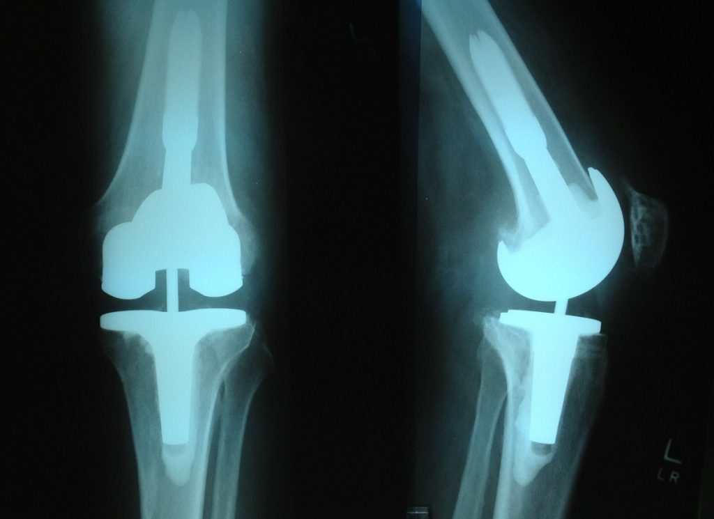 Total knee replacement